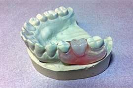 Unilatéral de dents